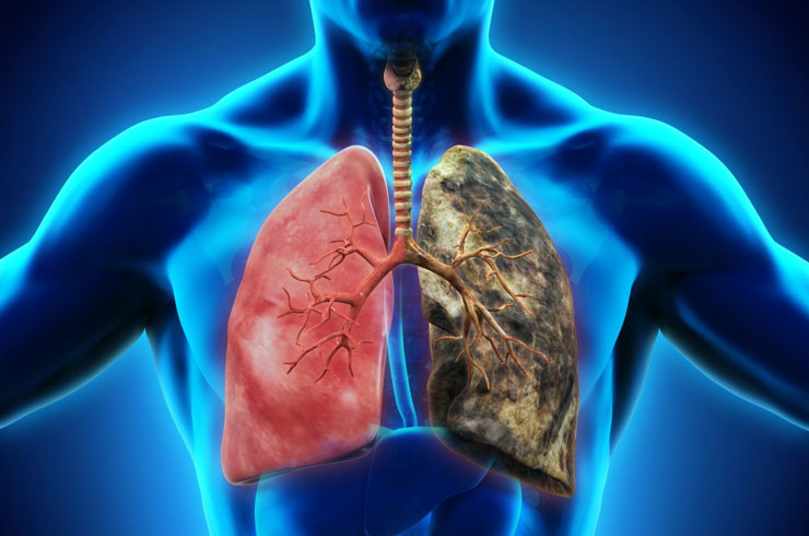Akciğer Kanseri Nedir? Akciğer Kanseri Belirtileri ve Nedenleri Nelerdir?
