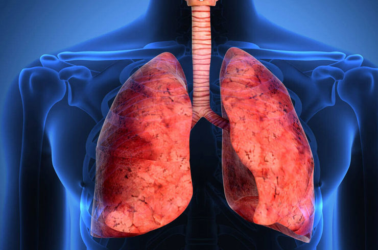 Akciğer Kanseri Tedavi Yöntemleri Nelerdir? Nasıl Teşhis Edilir?