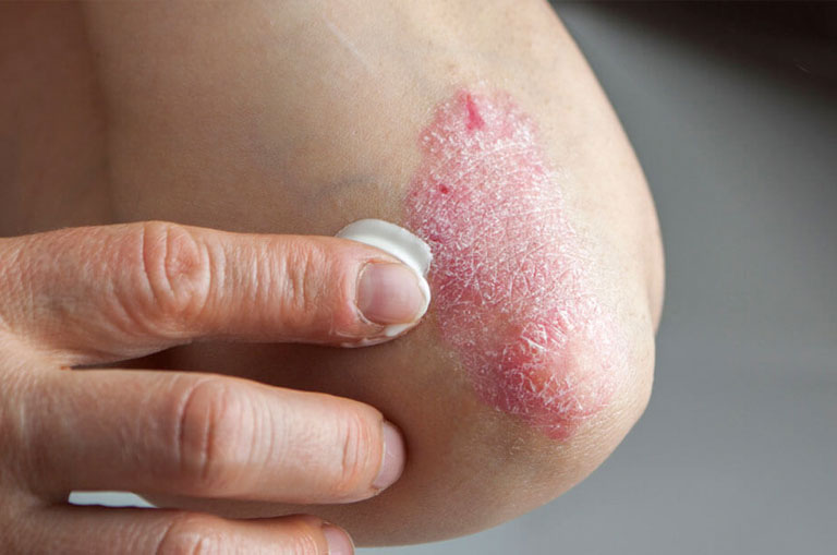 Egzama (Atopik Dermatit) Tedavi Yöntemleri Nelerdir? Nasıl Teşhis Edilir?