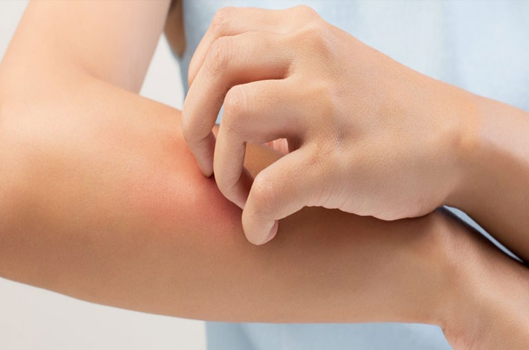 Egzama Hastalığı (Atopik Dermatit) Nedir? Belirtileri ve Nedenleri Nelerdir?