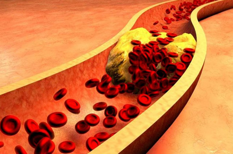 Damar Sertliği Nedir? Arteriyoskleroz / Ateroskleroz Belirtileri ve Nedenleri