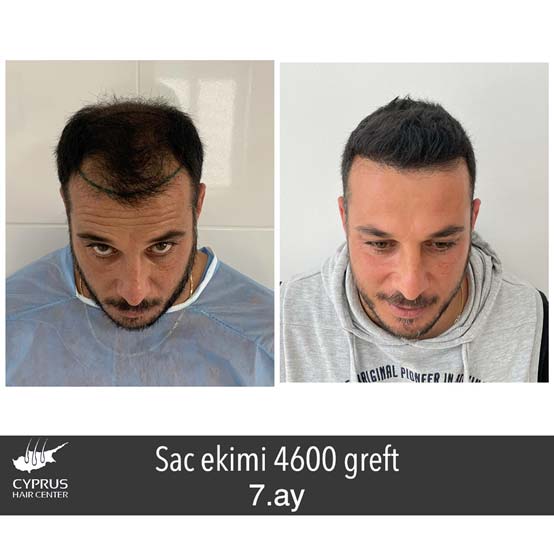 Cyprus Hair Center Saç Ekimi