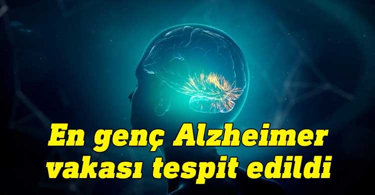 Çin'deki bir hafıza kliniğindeki nörologlar, 19 yaşındaki bir çocuğa Alzheimer hastalığı teşhisi koydular. Rapor, genci dünyada Alzheimer teşhis konulan en genç insan yaptı.