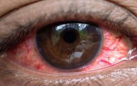 Uganda'da son 3 haftada bulaşıcı "kırmızı göz" (konjonktivit) hastalığına yakalananların sayısının 7 bin 500'ü geçtiği bildirildi.