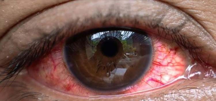 Uganda'da son 3 haftada bulaşıcı "kırmızı göz" (konjonktivit) hastalığına yakalananların sayısının 7 bin 500'ü geçtiği bildirildi.